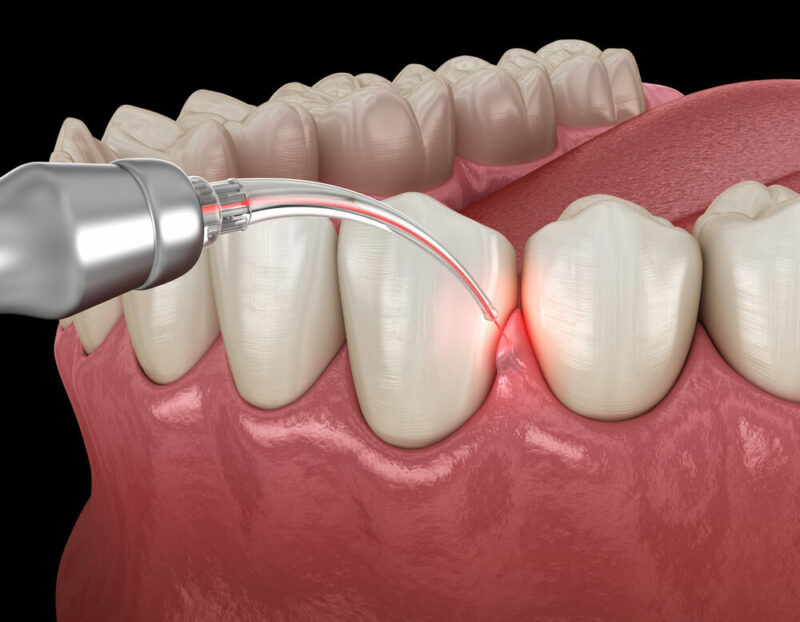 gum-surgery-perionw-burlington-wa